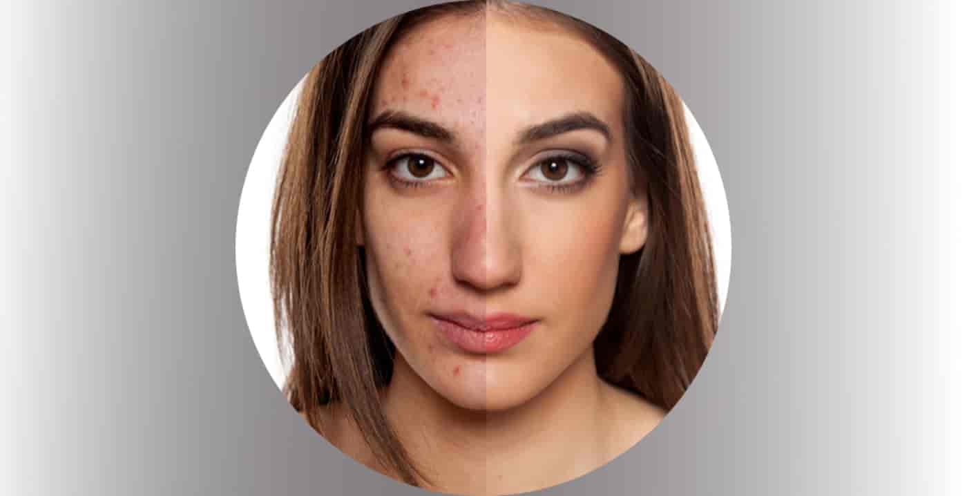 Dilluminaskin-acne-treatment