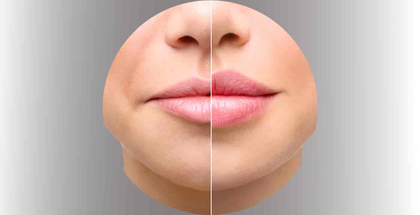 Dilluminaskin-derma-treatment