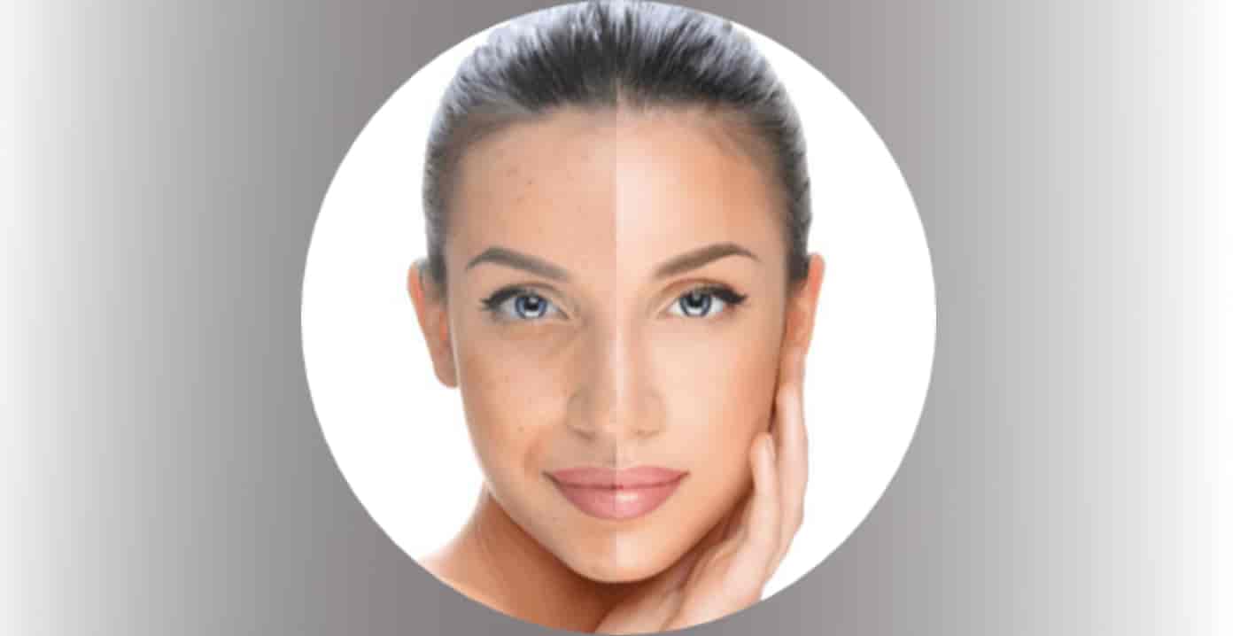 Dilluminaskin-meso-therapy-treatment