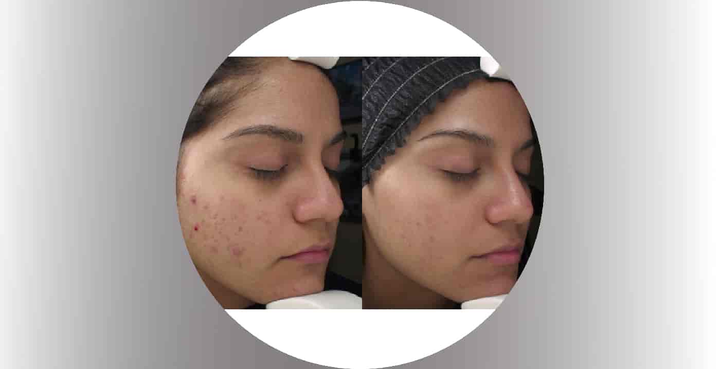 Dilluminaskin-scar-treatment