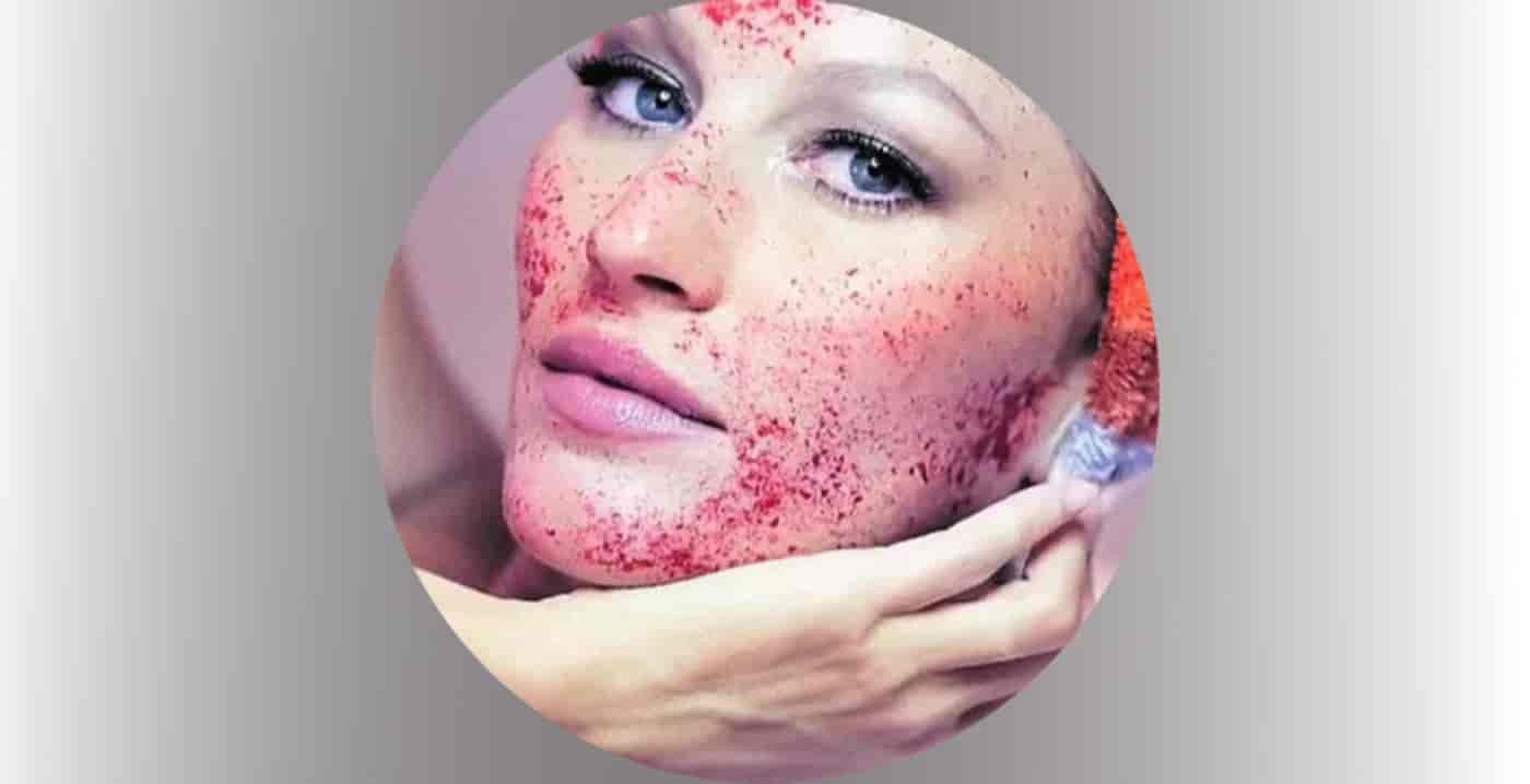 Dilluminaskin-vampire-facial-treatment
